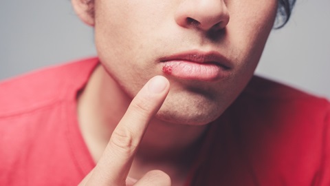 Dure middeltjes werken niet tegen herpes